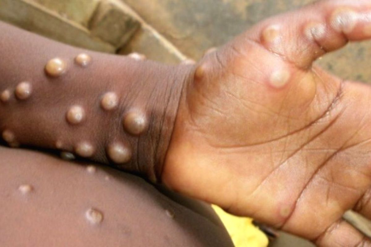 Variole du singe : ce n’est pas le singe la cause ; grosse révélation sur l'origine de la maladie