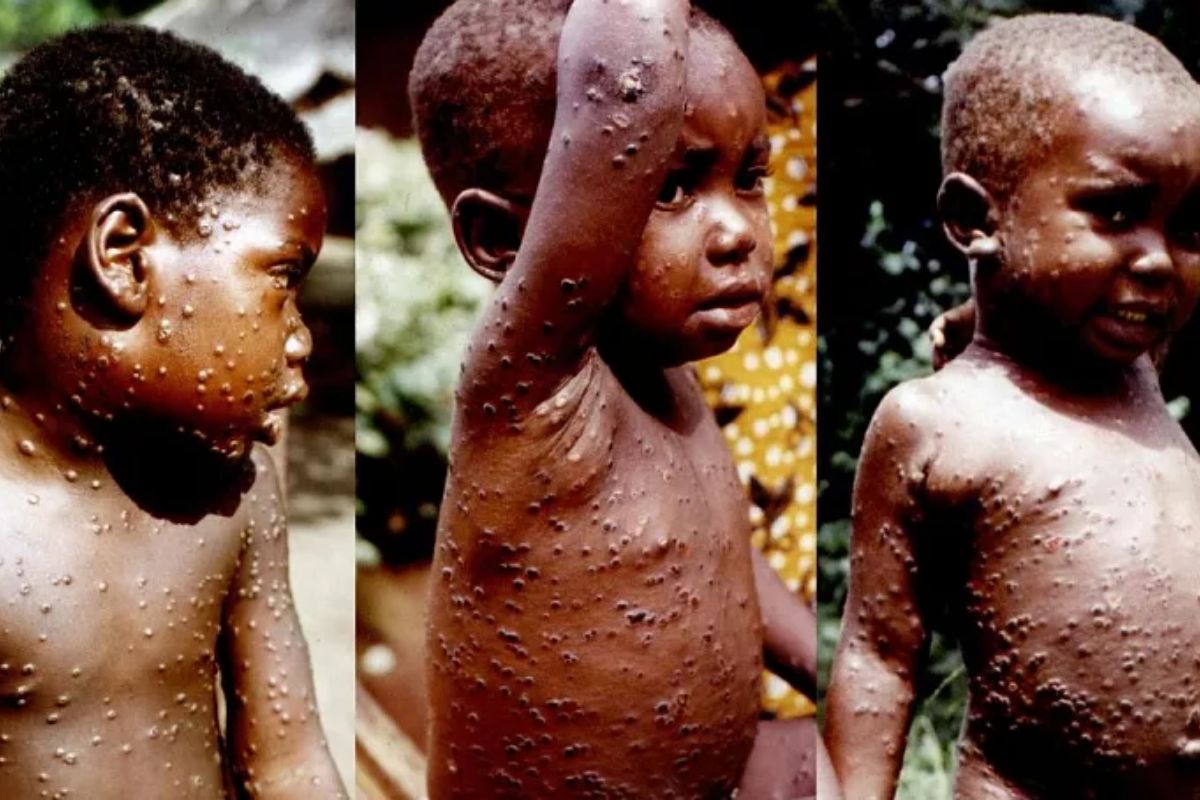 Variole du singe : la maladie toujours en évolution en Afrique de l'Ouest ? Ce pays déclare son premier cas