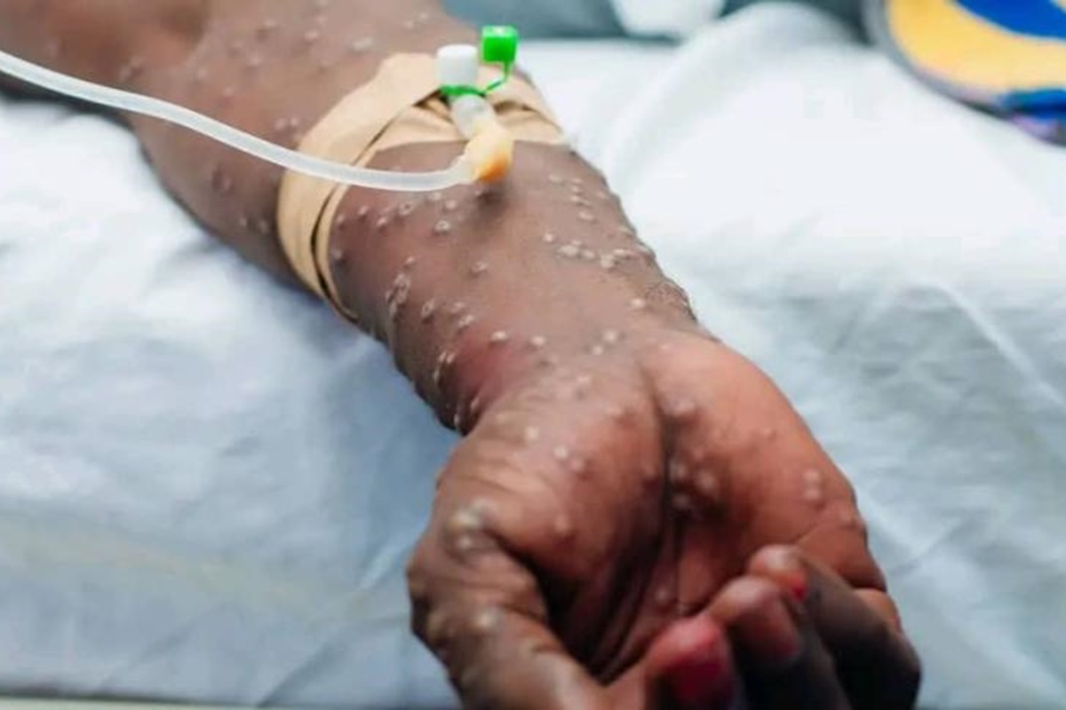 ‎Sénégal : le pays enregistre un nouveau cas de Mpox